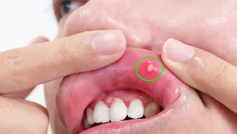 Kanserin Tehlikeli Belirtileri: Dil Alınmak Zorunda Kalındı!